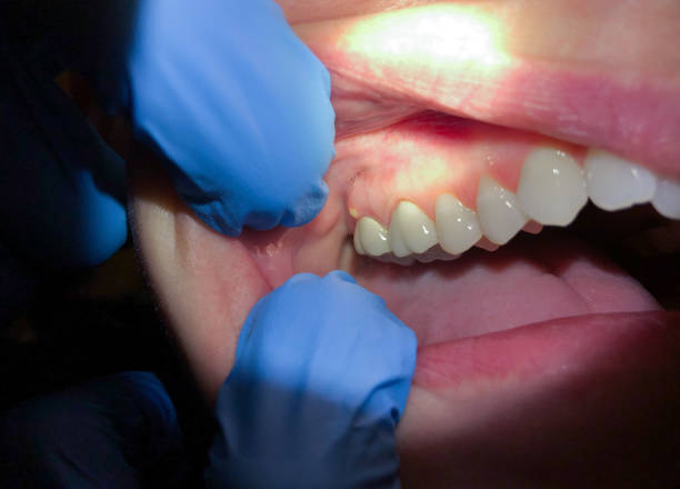Best Emergency Gum Treatment in Mountain Green, UT